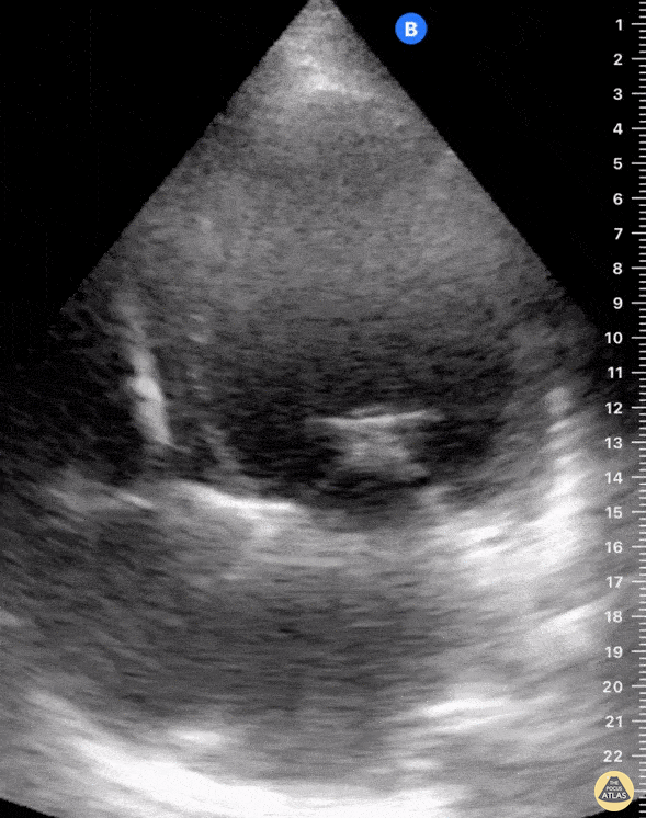 Valvulopathy - Mitral Clip