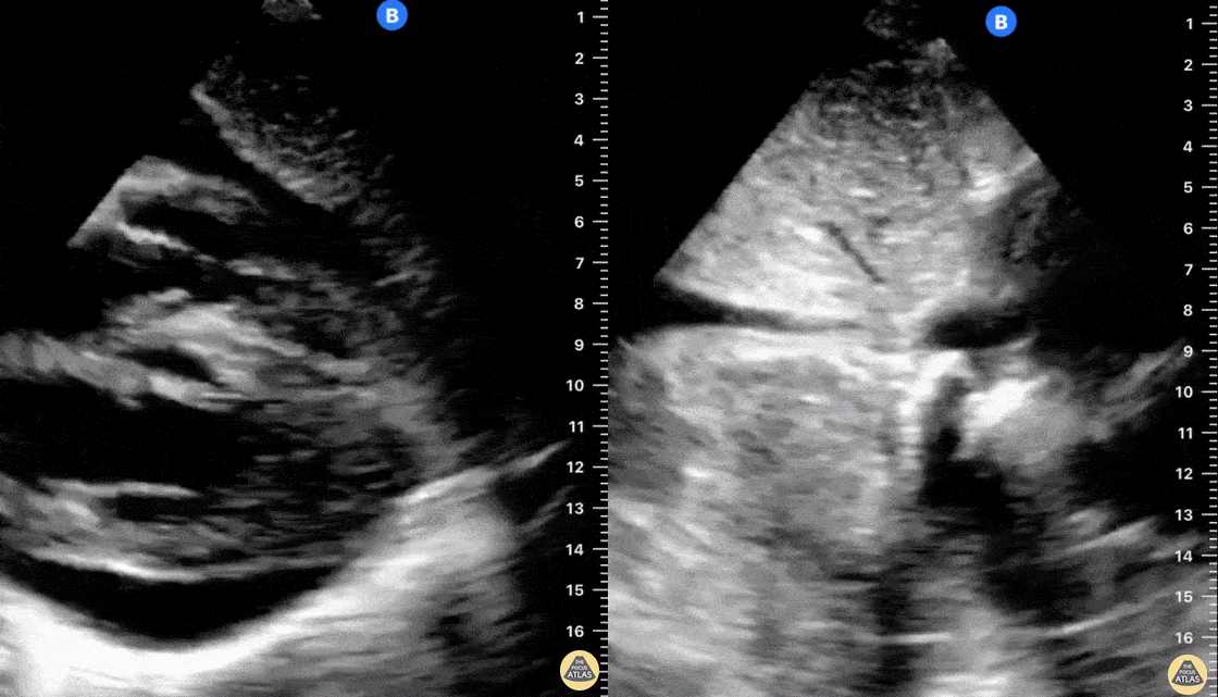 Pericardial Disease - Pericardial Effusion vs Tamponade
