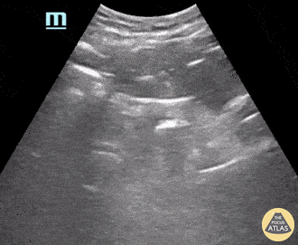 Renal/GU - Bladder Mass