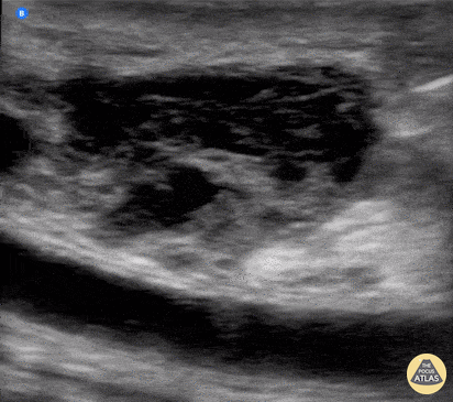 Soft Tissue - Image-Guided Needle Aspiration