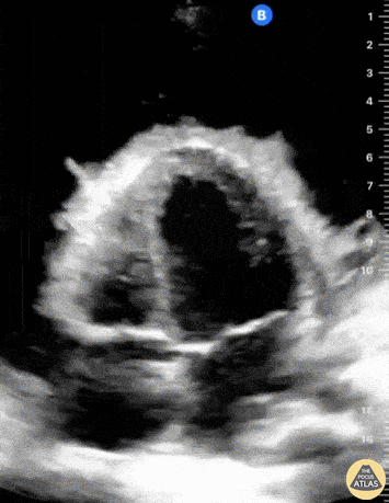 Pericardial Disease - Fibrinous Pericardial Effusion