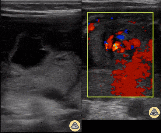Bowel-GI - Whirlpool Sign