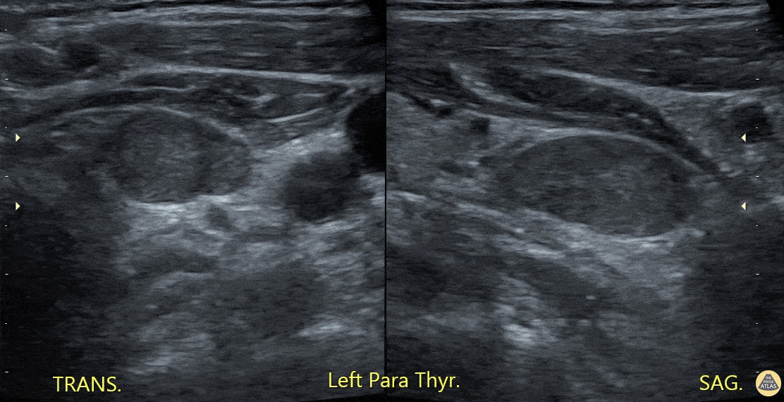Soft Tissue - Parathyroid Mass