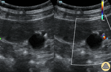 Biliary - Adenomyomatosis