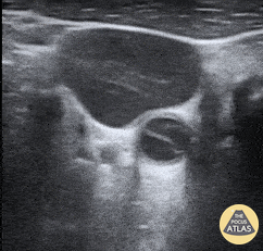 Vascular - Carotid Dissection