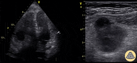 Right Ventricular Dysfunction - Clot in Transit & Femoral DVT