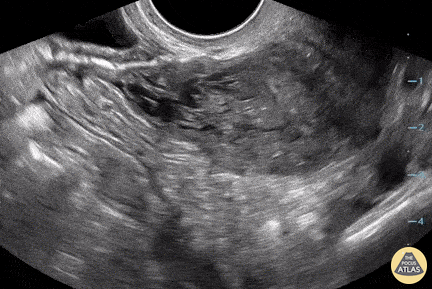 OB/Gyn - Ovarian Torsion