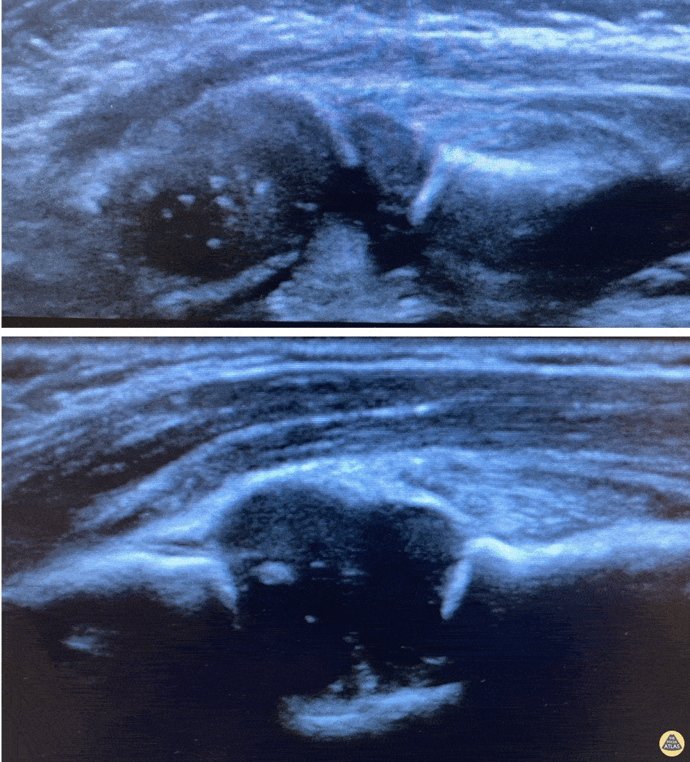 Musculoskeletal - Nursemaid's Elbow