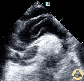 Thoracic Aortic Dissection & Aneurysm - Suprasternal View of Type A Dissection