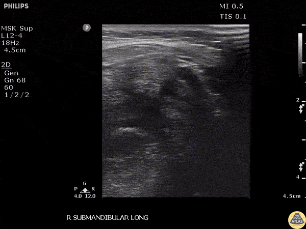 Soft Tissue - Submandibular Sialolithiasis