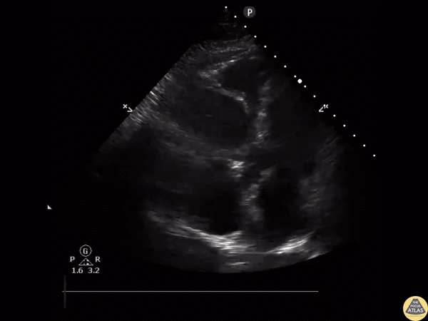 Right Ventricular Dysfunction - McConnell's Sign