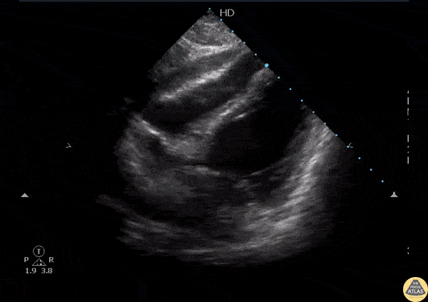 Pericardial Disease - Hemopericardium