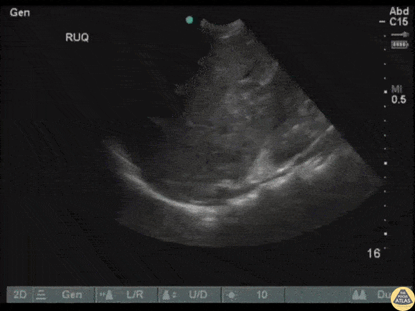 Trauma - Adrenal Hematoma
