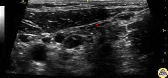 Nerve Block Gallery - Superficial Cervical Plexus Block