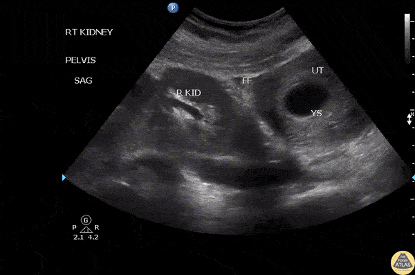 Renal/GU - Pelvic Kidney