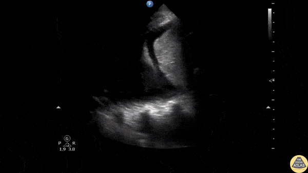 Pulmonary - Hemothorax
