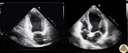 Left Ventricular Dysfunction - Takotsubo Cardiomyopathy