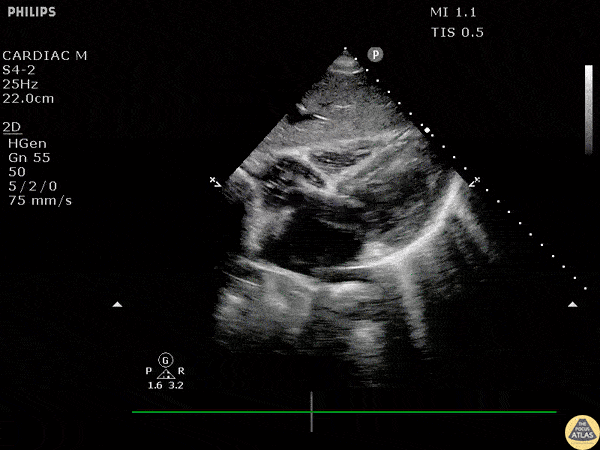 Left Ventricular Dysfunction - Ventricular Fibrillation