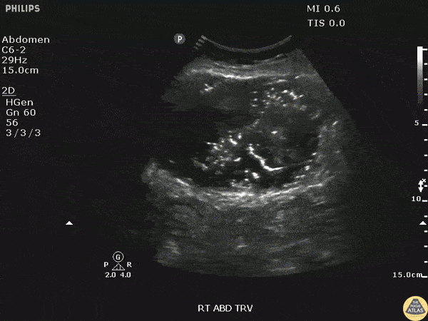 Bowel-GI - Intra-abdominal Abscess