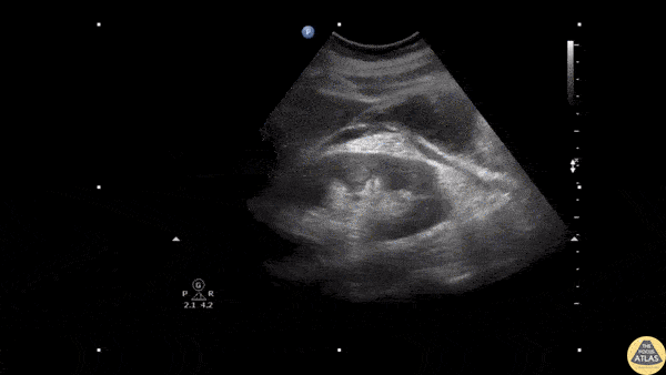 Bowel-GI - Retroperitoneal Hemorrhage