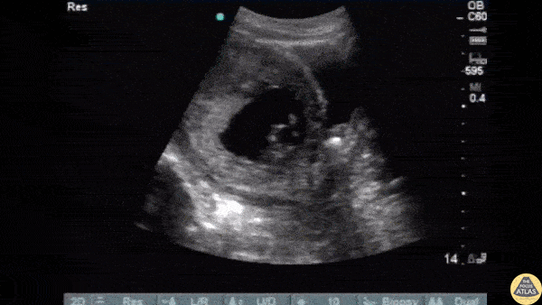 Renal/GU - Ureteral Stone during Pregnancy