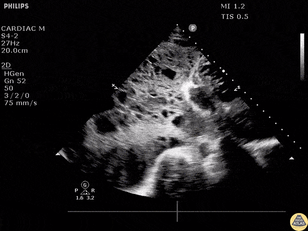 Pulmonary - Malignant Pleural Effusion