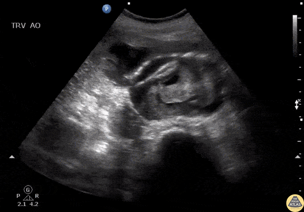 Aorta - Ruptured AAA