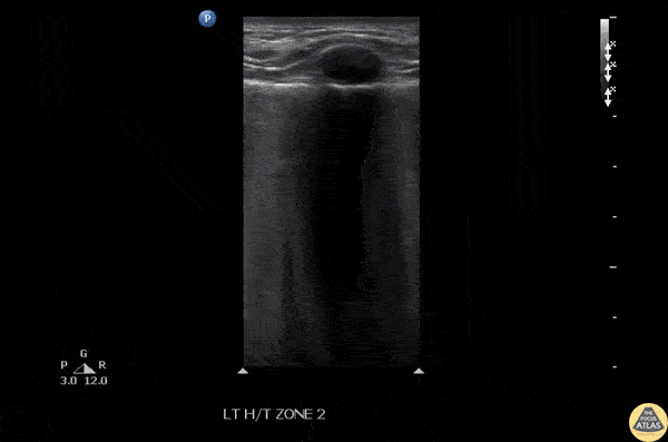 Pulmonary - B Lines with Irregular Pleura