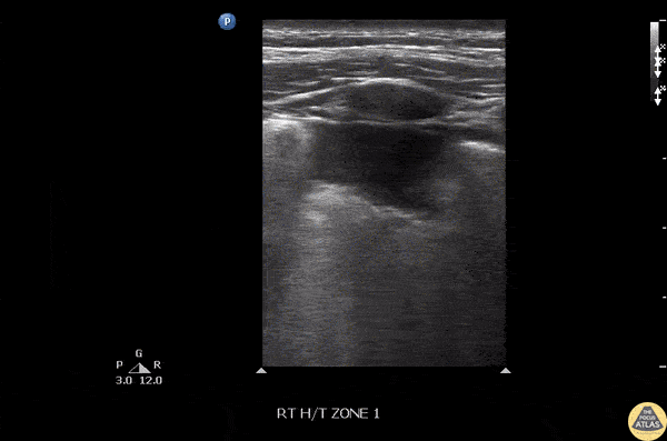 Pulmonary - Pneumonia-Subpleural Consolidation