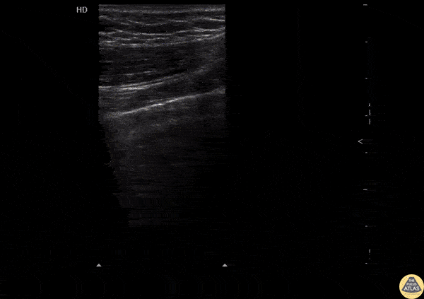 Pulmonary - Normal Lung Sliding