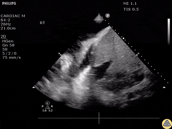 Pulmonary - Pneumonia-Parapneumonic Effusion