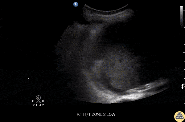 Pulmonary - Pneumonia-Parapneumonic Effusion