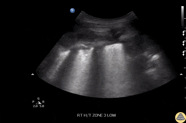 Pulmonary - Pnuemonia-Thickened Pleura