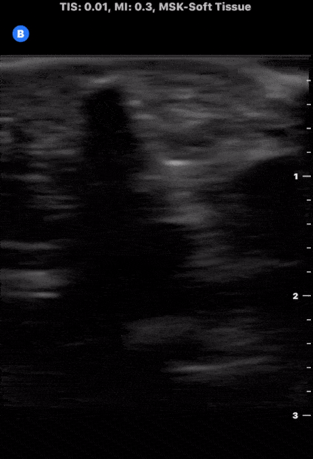 Soft Tissue - Soft Tissue Foreign Body