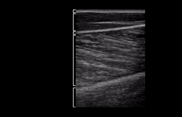 Soft Tissue - Soft Tissue Layers