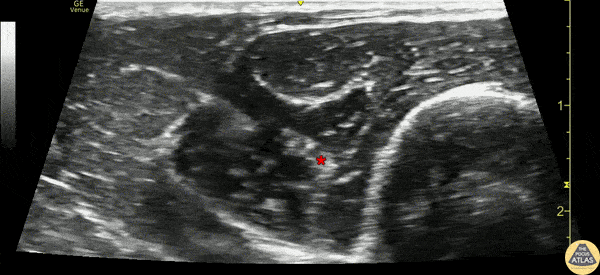 Nerve Block Gallery - Radial Nerve Block at the Elbow 2