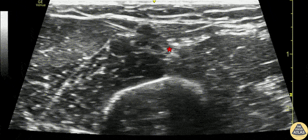 Nerve Block Gallery - Median Nerve Block at the Elbow