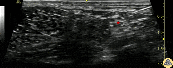 Nerve Block Gallery - Popliteal Sciatic Nerve Block