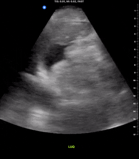 Trauma - Positive LUQ View