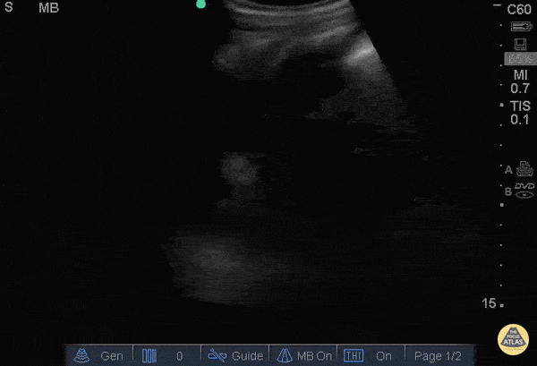 Trauma - Free Fluid in LUQ