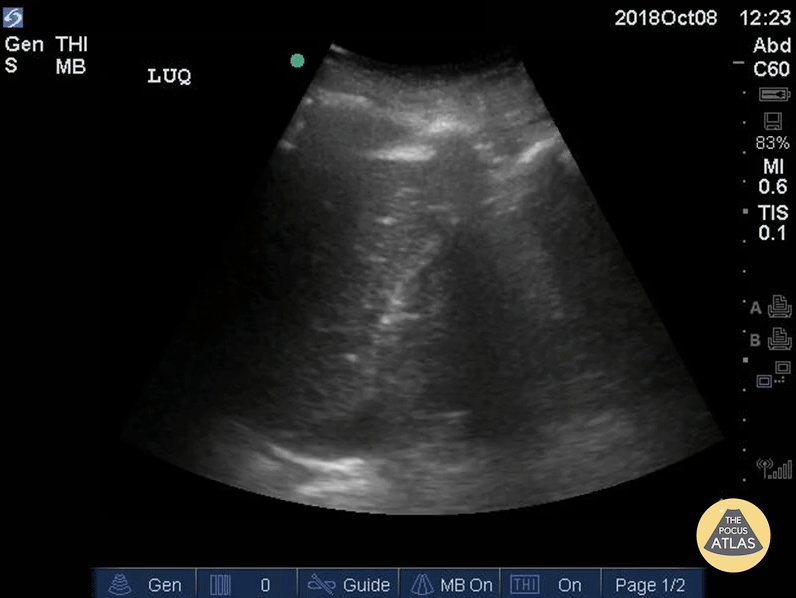 Trauma - Subtle Positive FAST - LUQ