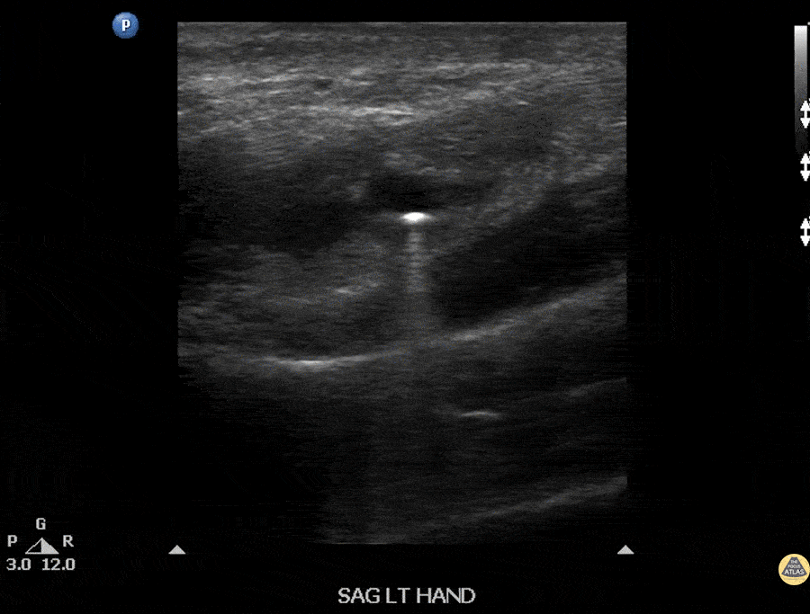 Soft Tissue - Foreign Body: BB within Hand
