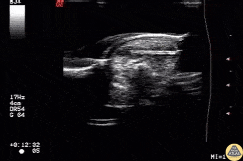 Soft Tissue - Foreign Body: Wooden Splinter