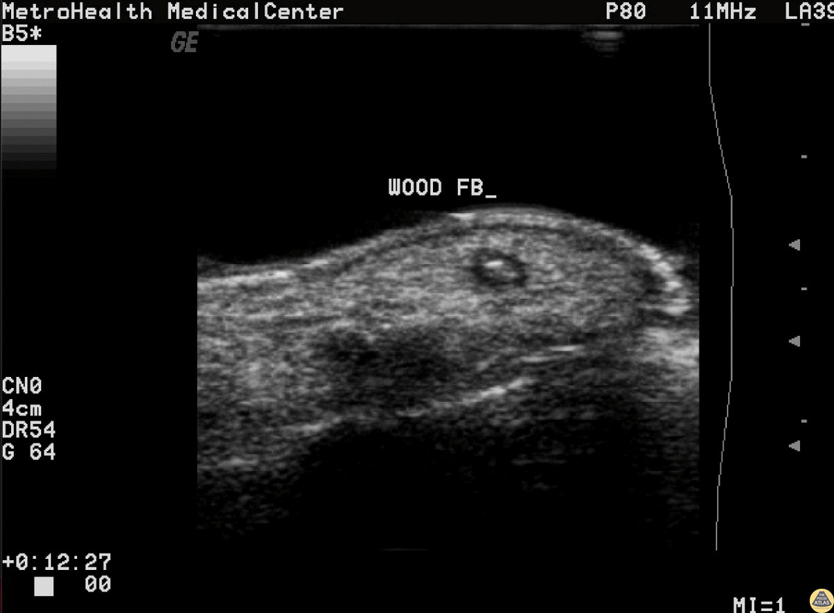 Soft Tissue - Wooden Splinter