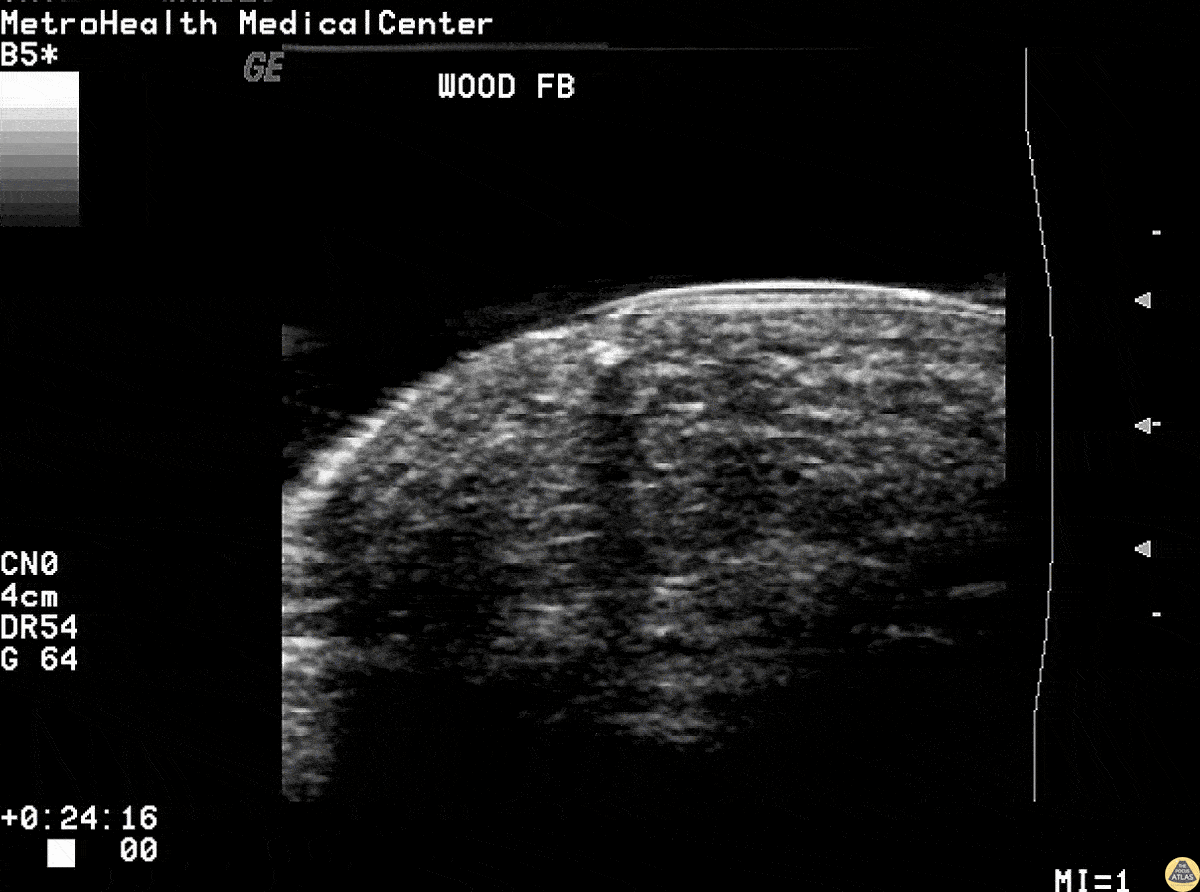 Soft Tissue - Wood Splinter Foreign Body