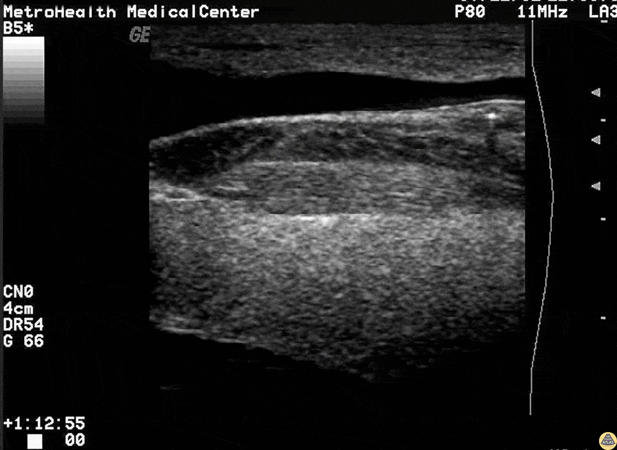 Soft Tissue - Broken Needle