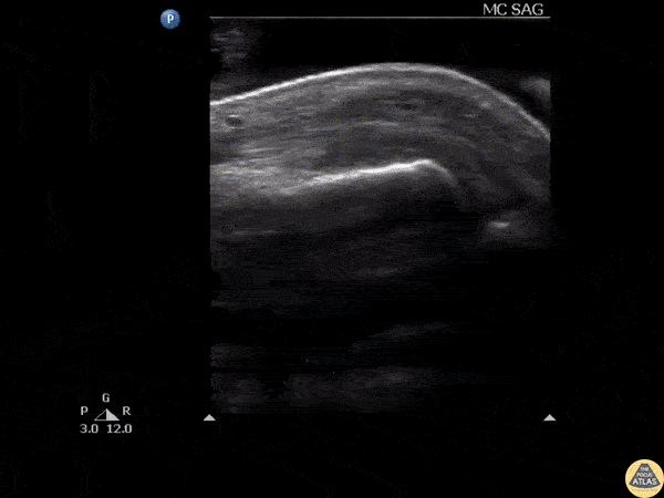 Soft Tissue - Glass FB in Extensor Tendon
