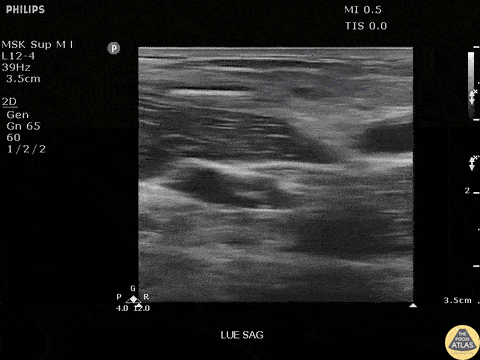 Soft Tissue - Bamboo Foreign Body