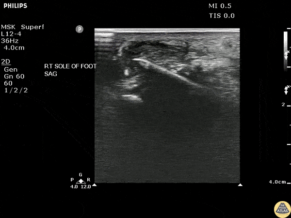 Soft Tissue - Toothpick Foreign Body