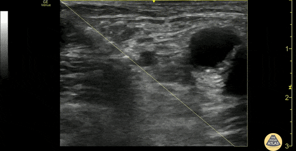 Nerve Block Gallery - Fascia Iliaca Nerve Block